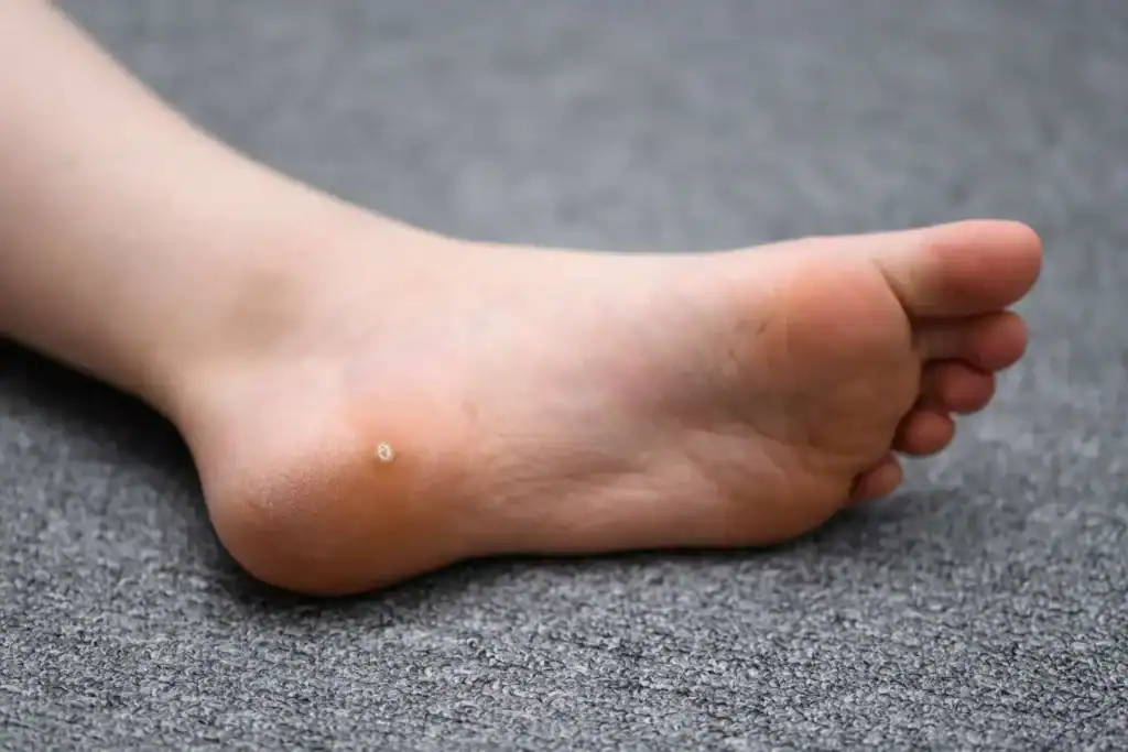 Cryotherapy For Warts And Also Verrucas 2 Image of verruca on the bottom of the foot that able to be treated with Cryotherapy Salisbury