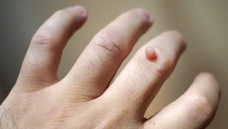Cryotherapy For Warts And Also Verrucas 1 Image of blemish that Cryotherapy Salisbury can remove with Lipo 360.