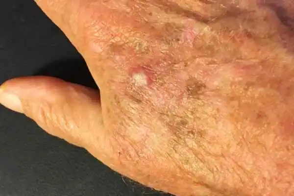Cryopen For Actinic Keratoses 1 Image of Actinic keratoses Salisbury on a person hand