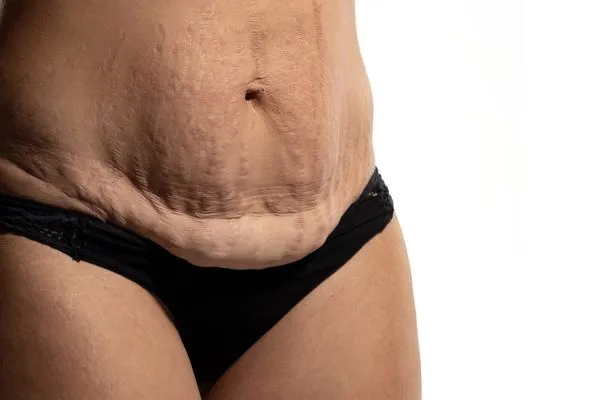 The Science of Skin Tightening 1 The science behind skin tightening Salisbury picture of a woman's sagging skin on the stomach